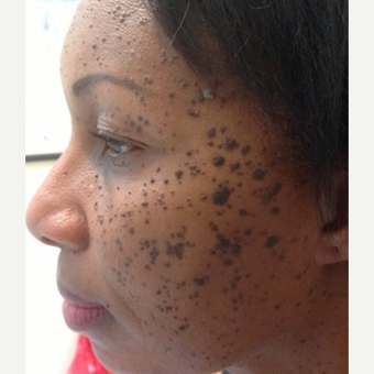 45-54 year old woman treated with Mole Removal before 3453469