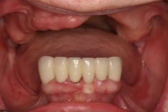 Same Day Teeth- Immediate implants and teeth before 946768