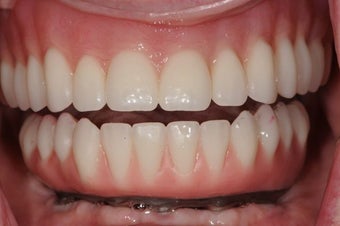 Same Day Teeth- Immediate implants and teeth after 946768