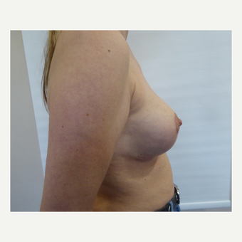 35-44 year old woman treated with Breast Lift after 3428294