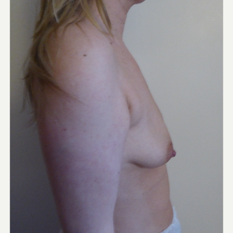 35-44 year old woman treated with Breast Lift before 3428294