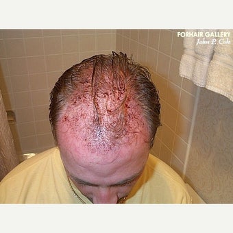 Hair Transplant Results - Patient 1631128