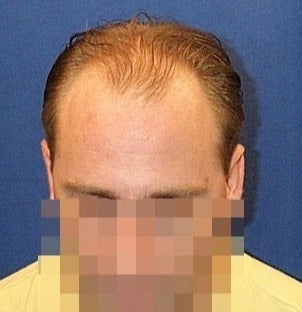 Hair Transplant Results - Patient before 1631128