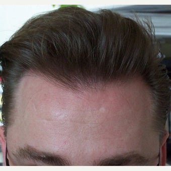 Hair Transplant Results - Patient after 1631128