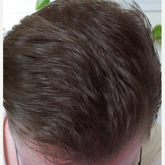 Hair Transplant Results - Patient 1631128
