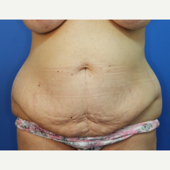 55-64 year old woman treated with Tummy Tuck before 3382951