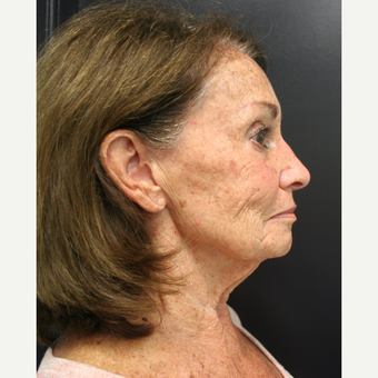 65-74 year old woman treated with SMAS Facelift before 3405802
