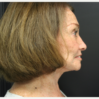 65-74 year old woman treated with SMAS Facelift after 3405802