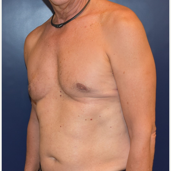 55-64 year old man treated with Male Breast Reduction after 3384885