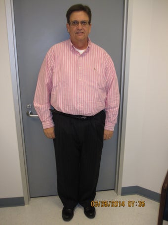Gastric Bypass Before & After after 1275798