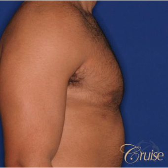 26 year old man treated with Male Breast Reduction after 3196770