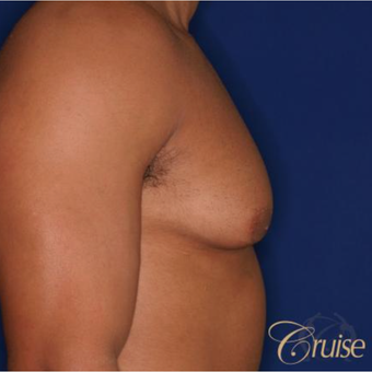 26 year old man treated with Male Breast Reduction before 3196770