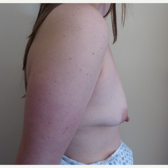 25-34 year old woman treated with Breast Lift before 3428123