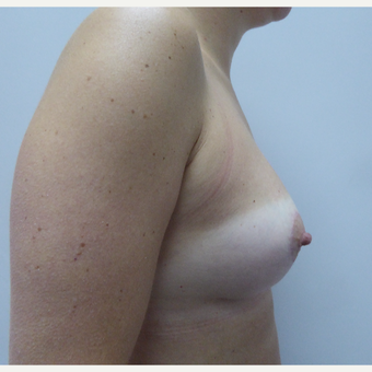 25-34 year old woman treated with Breast Lift after 3428123