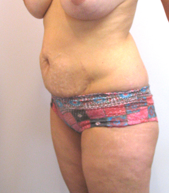 32 year old woman treated with Tummy Tuck before 3753994