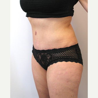 32 year old woman treated with Tummy Tuck after 3753994