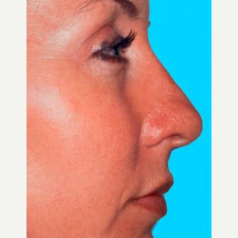Rhinoplasty after 3814321