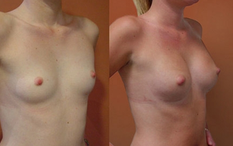 Breast Implants before 974251