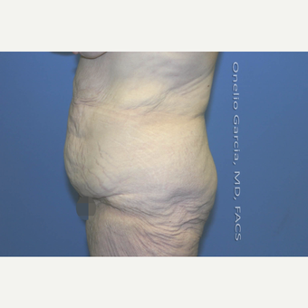 45-54 year old woman treated with Body Lift-Circumferential "Belt" lipectomy + Vaser Liposuction before 3041539