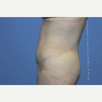 45-54 year old woman treated with Body Lift-Circumferential "Belt" lipectomy + Vaser Liposuction after 3041539