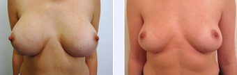 35 Year Old Female Breast Implant Removal Patient before 1346697