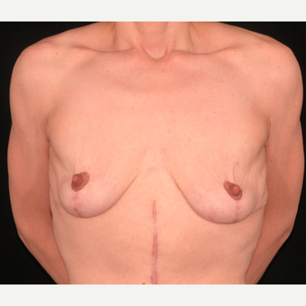 35 year old woman treated with Breast Lift after 3052690