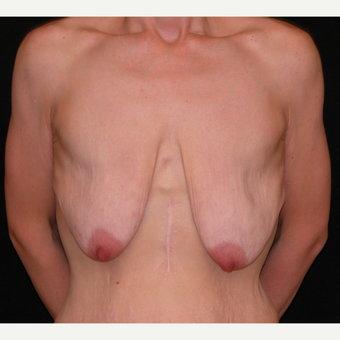 35 year old woman treated with Breast Lift before 3052690