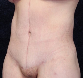 35 Year Old Female, Beltlift After Gastric Bypass after 1409517