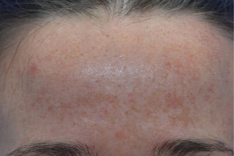 25-34 year old woman treated with Age Spots Treatment before 3141147