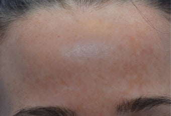 25-34 year old woman treated with Age Spots Treatment after 3141147