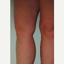 45-54 year old woman treated with EVLT after 2533277