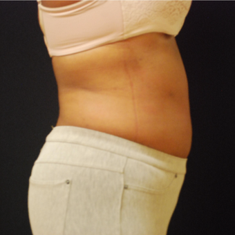 45-54 year old woman treated with Vanquish after 3500850