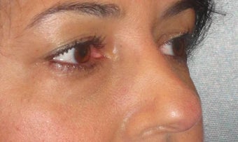 Restylane after 971880
