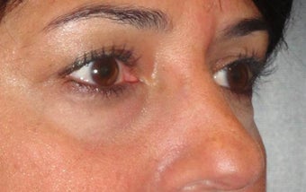 Restylane before 971880