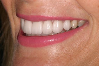 Porcelain crowns 368662