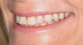 Porcelain crowns 368662