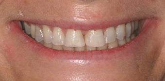 Porcelain crowns before 368662