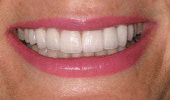 Porcelain crowns after 368662