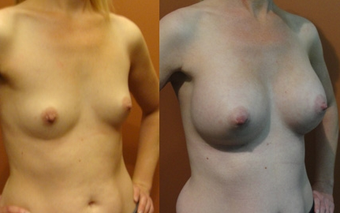 Breast Implants before 975840