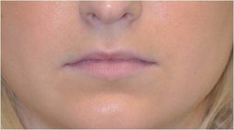 Permalip lip implant for young women that desired permanent and natural lip augmentation before 1081517