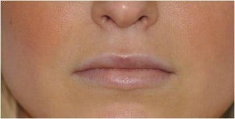 Permalip lip implant for young women that desired permanent and natural lip augmentation after 1081517