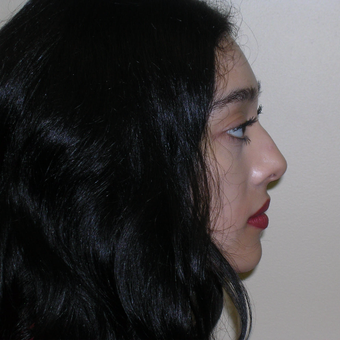 18-24 year old woman treated with Rhinoplasty before 3264770