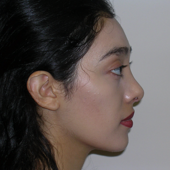 18-24 year old woman treated with Rhinoplasty after 3264770