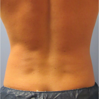 25-34 year old man treated with CoolSculpting after 3763973