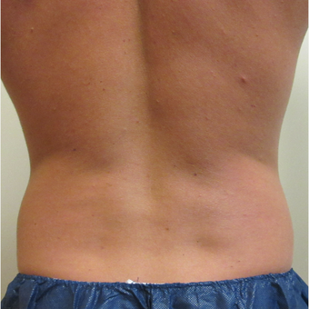 25-34 year old man treated with CoolSculpting before 3763973