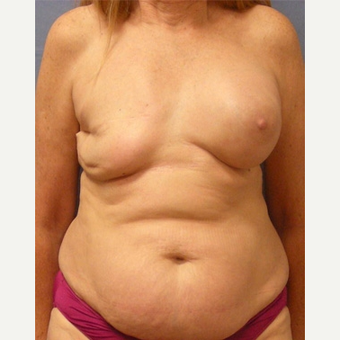 55-64 year old woman treated with Breast Reconstruction before 3630773