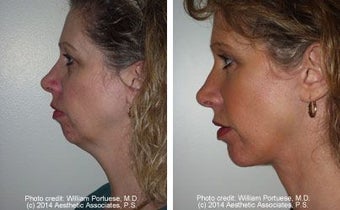 Facelift with Chin Implant, Dermabrasion before 91414