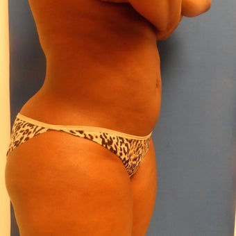 Patient Case #Top Brazilian buttocks after 2088064