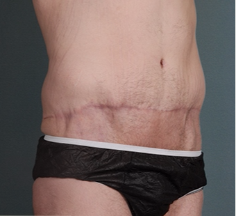26 year old man treated with Tummy Tuck after 3762908