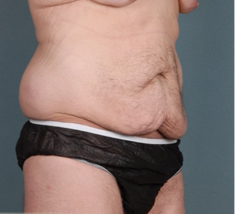 26 year old man treated with Tummy Tuck before 3762908